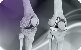 Total Knee Replacement