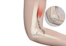 Distal Bicep Repair