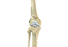 Distal Femoral Osteotomy