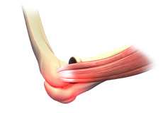 Elbow Sprain