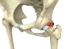 Femoroacetabular Impingement