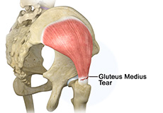 Gluteus Medius Tear