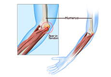 Golfer's Elbow Surgery