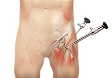 Hip Arthroscopy