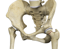 Hip Fracture