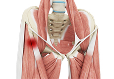 Hip Tendonitis