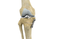 Knee Osteotomy