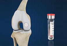 Matrix Autologous Chondrocyte Implantation (MACI)