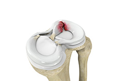 Meniscus Tears