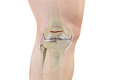 Fractures of the Patella