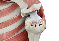 Rotator Cuff Repair