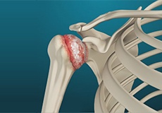 Shoulder Arthritis