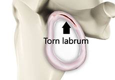 Shoulder Labrum Tears