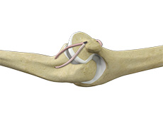UCL Tear (Ulnar Collateral Ligament)